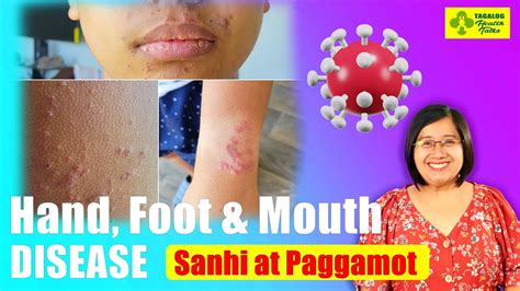 disease in Tagalog .